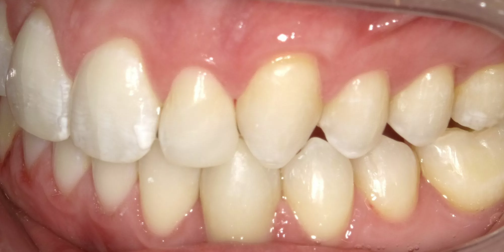 Invisalign 6 after