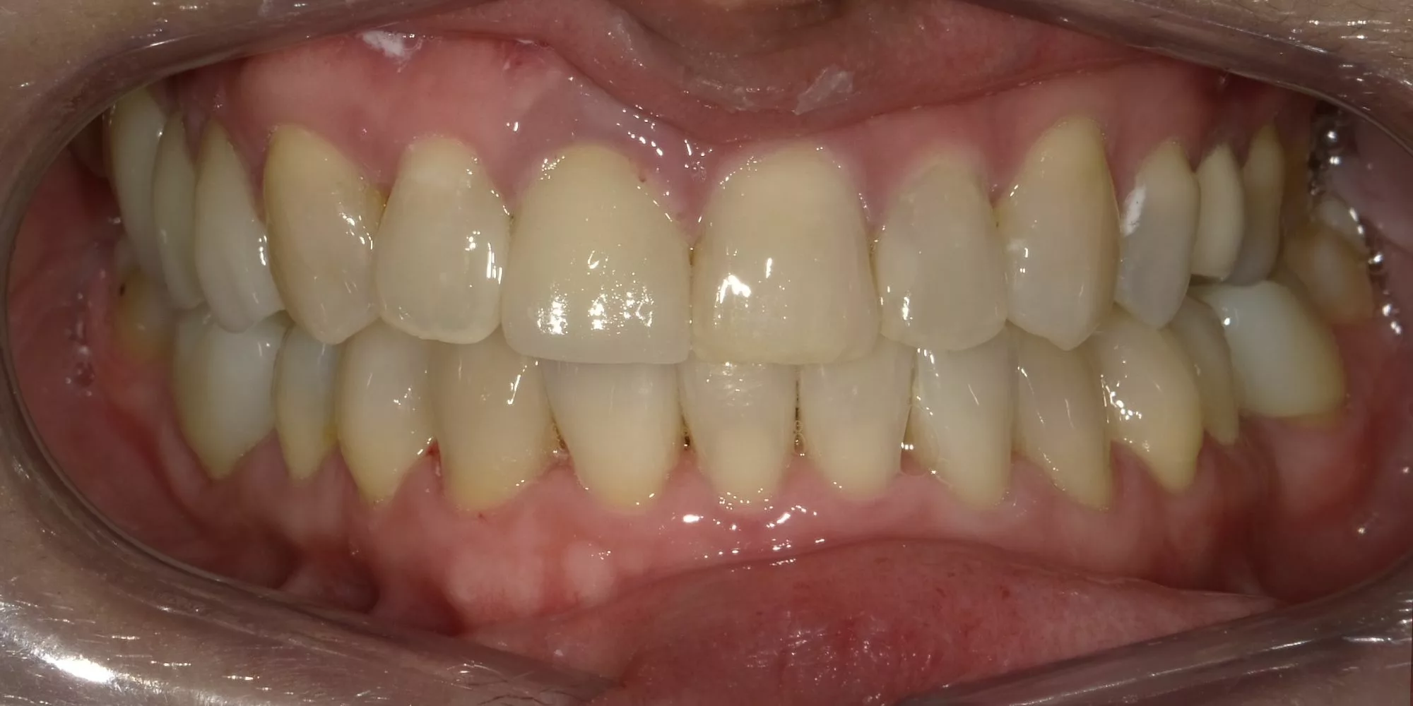 invisalign 1 after