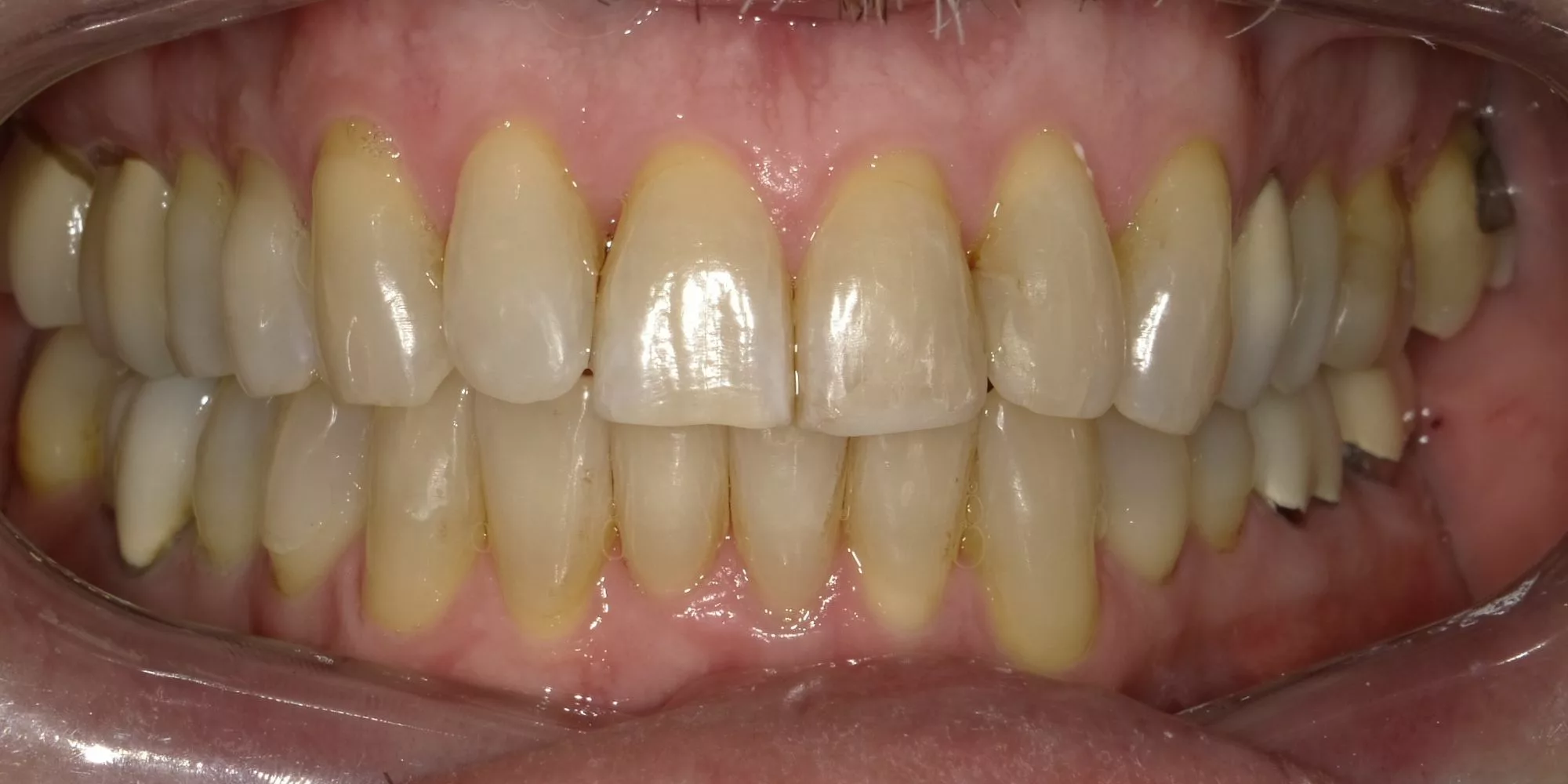 invisalign 3 after