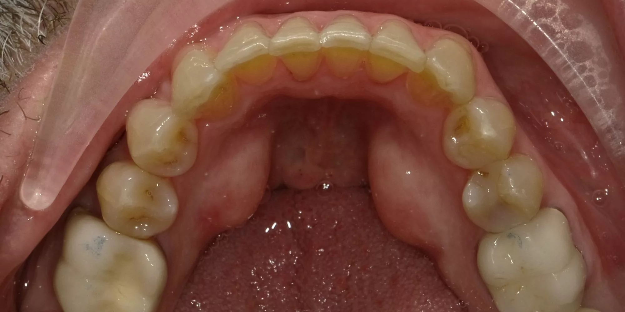 invisalign 4 after
