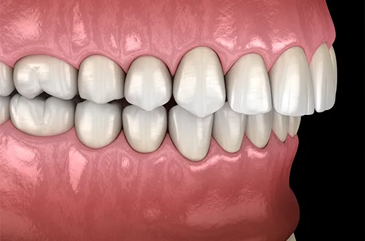 Can Invisalign fix overbite